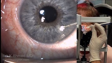 Glaucoma Drug Delivery into the Eye: Durysta Bioerodible Implant
