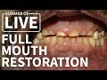 Full Mouth Dental Restoration - LIVE Treatment