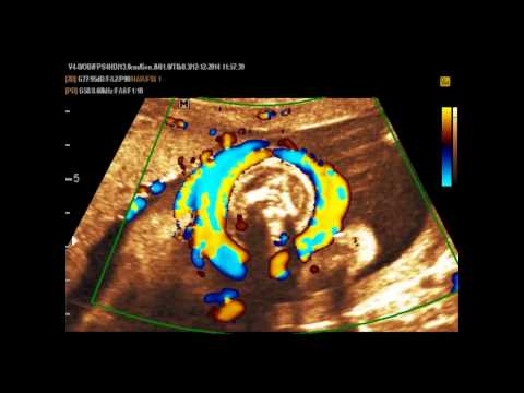 Video: Emodinamica Fetale Di Transizione E Scambio Gassoso Nell'adattamento Postpartum Prematuro: Serraggio Immediato O Ritardato Del Cordone