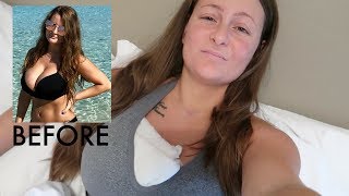 BREAST REDUCTION | Surgery - 1 Week Post-op! Pictures, FAQs + more
