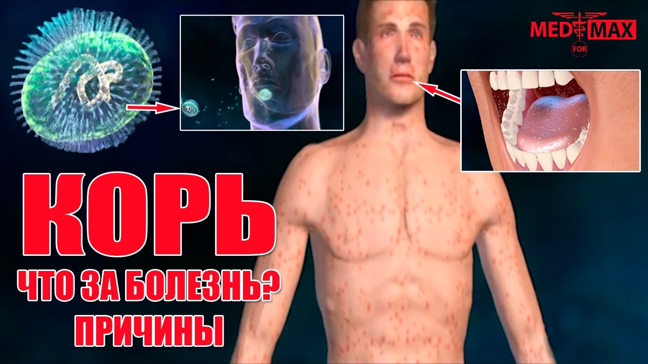 Корь - острое вирусное заболевание. Что за болезнь? Причины. Симптомы # ...