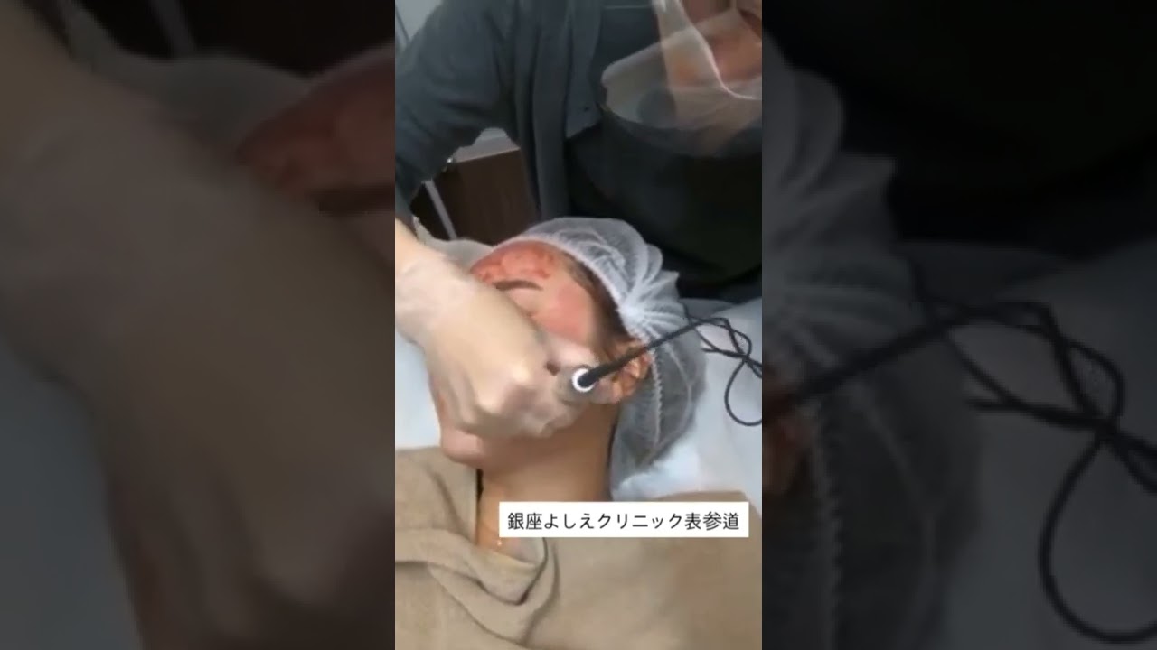 ダーマペン4｜美容皮膚科 銀座よしえクリニック【公式】東京
