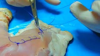 Surjet Pé Technique De Suture