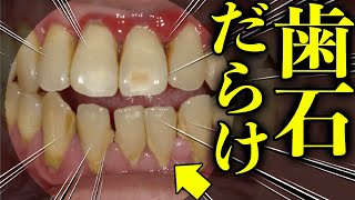 歯石が溜まりすぎて　歯茎が真っ赤っ赤になりました　Too much tartar has accumulated and the gums have turned bright red　歯医者かおり