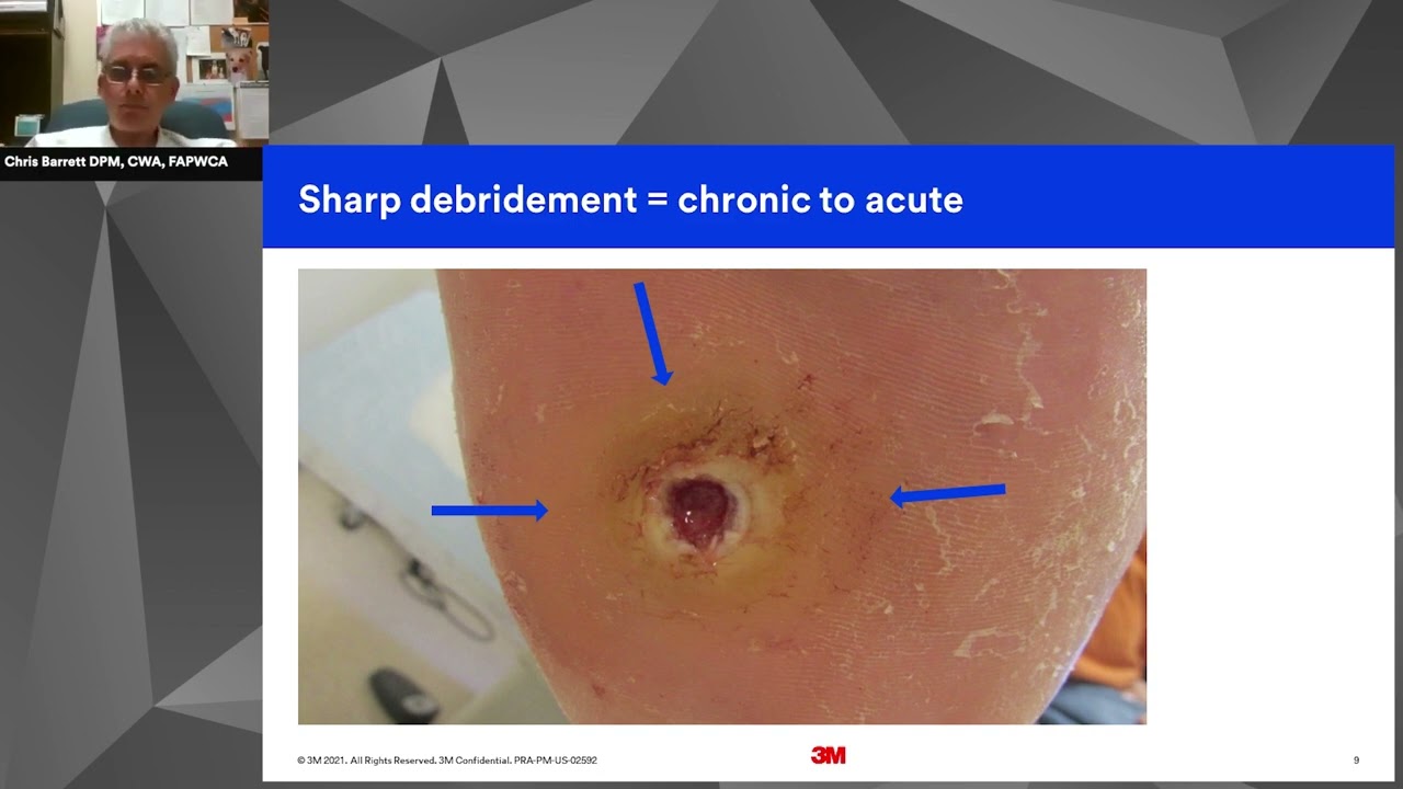 3M™ Snap™ Therapy System Plantar DFU-Dr Barrett - YouTube
