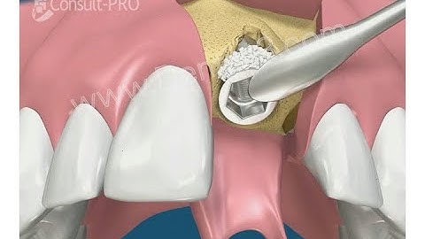 Dental Implant Placement using Guided Bone Regeneration (GBR)