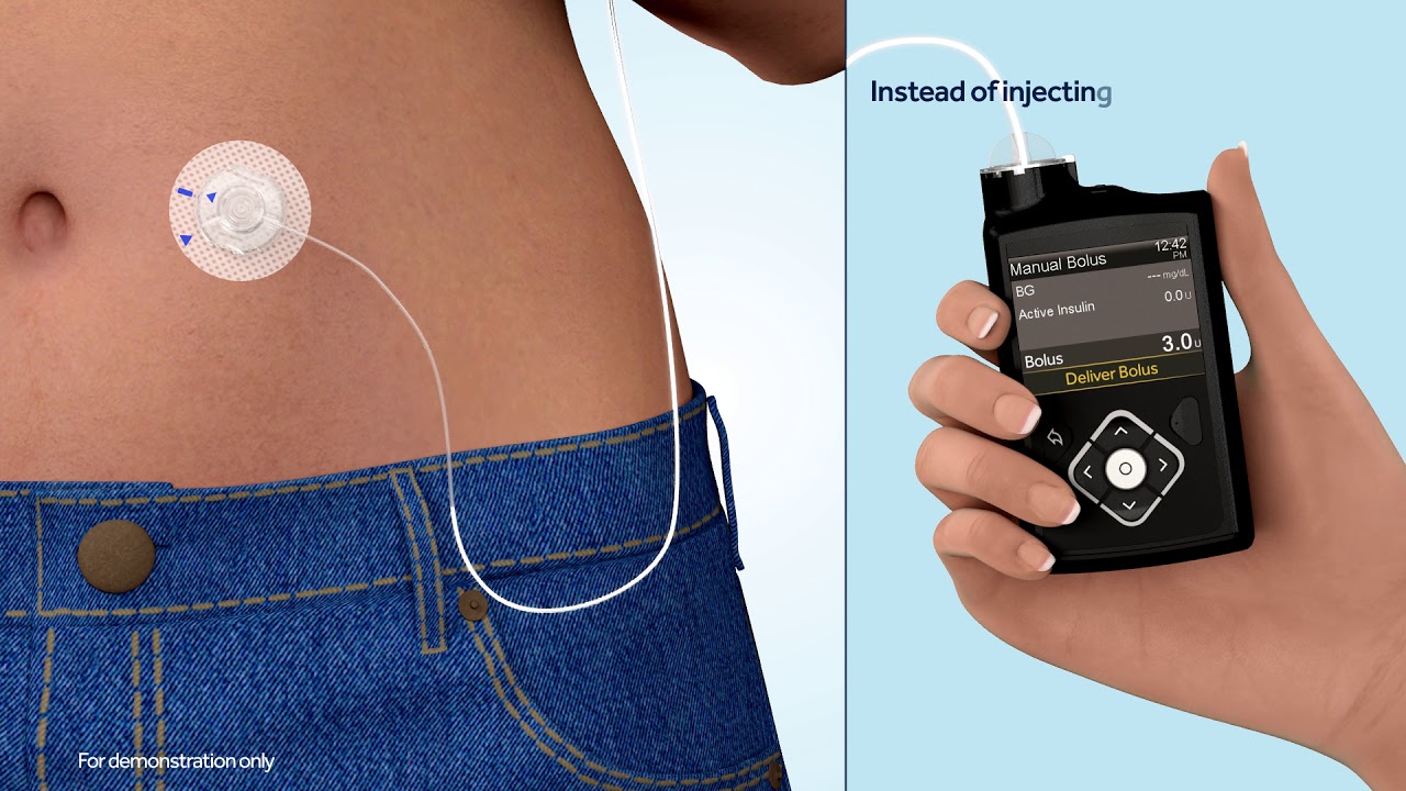 continuous insulin pump