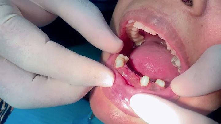 Before & After Smile Makeover Transformations | Dr. Shafeer | Best Dentist in Sharjah