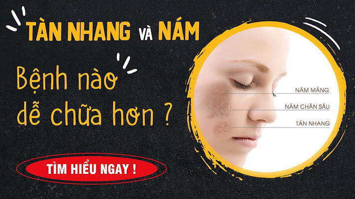 Nám và tàn nhang cái nào dễ chữa năm 2024