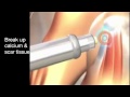 What is Shockwave Therapy? | Pain Relief