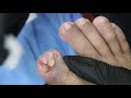 EP_1029 Ingrown toenail removal 👣 เป็นมา 2 ปีกว่า..เล็บแทบไม่มี 😡 (This clip from Thailand)