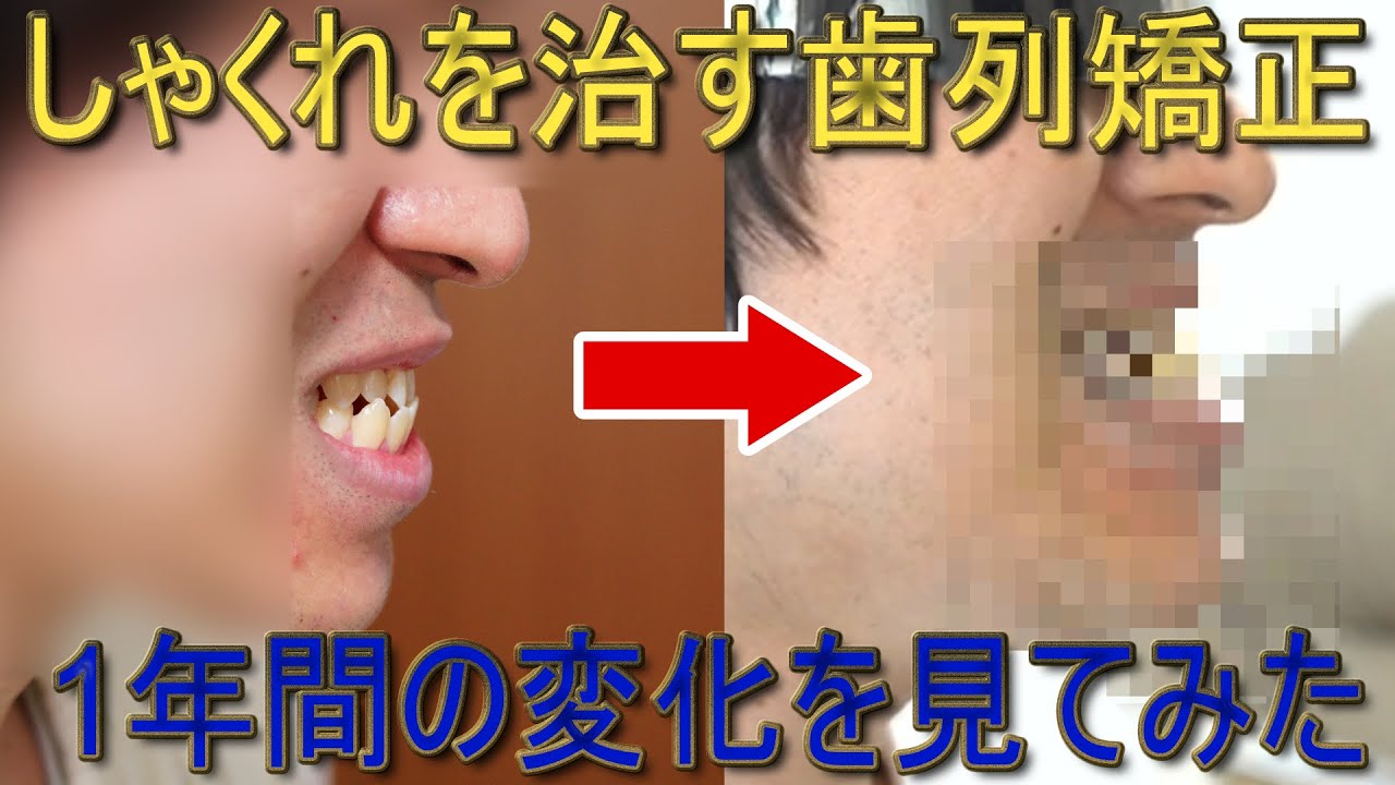 しゃくれを治すための歯列矯正を1年やった結果!【下顎前突・受け口】 - YouTube