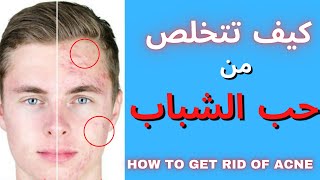 كيف تتخلص من حب الشباب نهائيا |  HOW TO GET RID OF ACNE