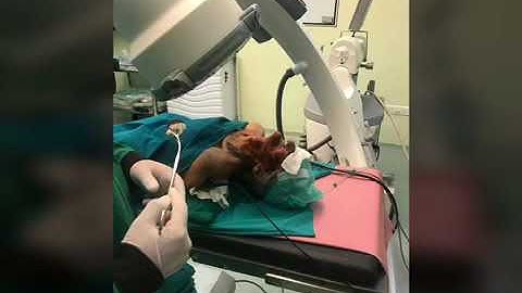 Gasserian Ganglion Block for trigeminal neuralgia