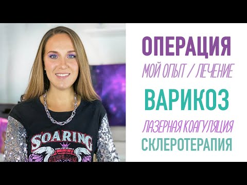 ВАРИКОЗ. Мой опыт. Лечение. Склеротерапия, лазерная коагуляция вен (абляция). ЦЕНА процедуры.