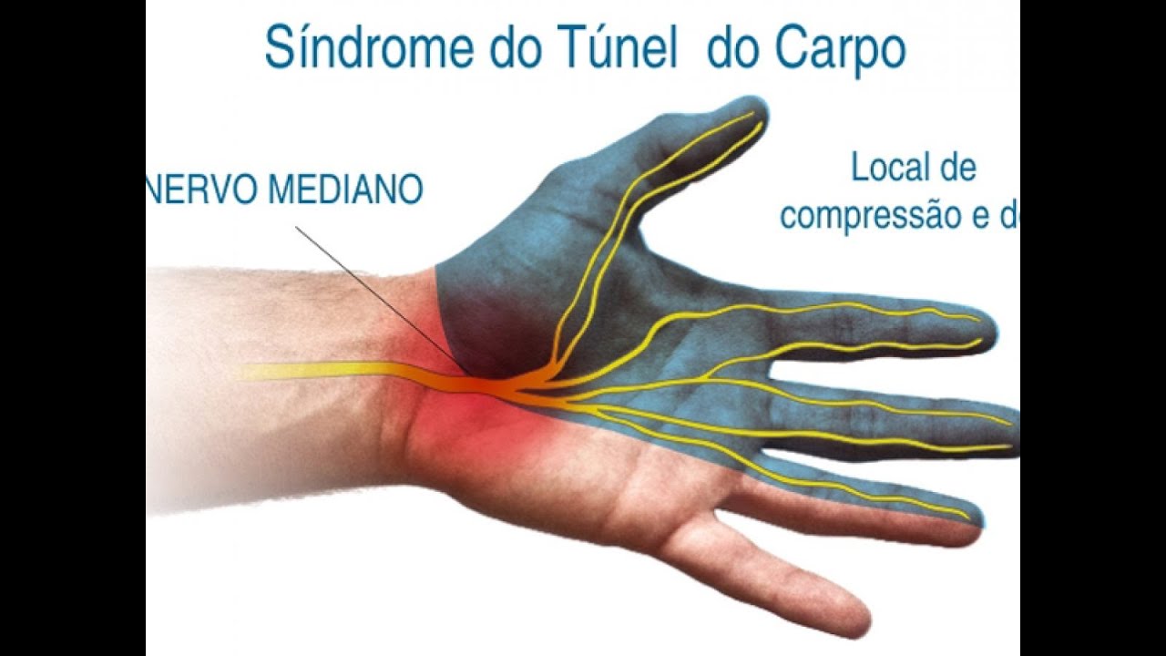 Síndrome do Túnel do Carpo O QUE É? CAUSAS SINTOMAS TRATAMENTO Clínica Fisioterapia Dr. Robson Síndrome do Túnel do Carpo O QUE É? CAUSAS SINTOMAS TRATAMENTO Clínica Fisioterapia Dr. Robson