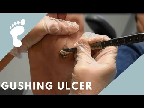 slicing-bloody-ulcer-|-lexington-podiatry