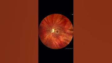 Dry AMD - geographic atrophy #retina #oftalmo #ophthalmology #oftalmologia #oftalmología #ophtalmol