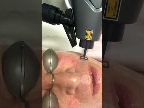 COMO FUNCIONA O LASER ERBIUM?