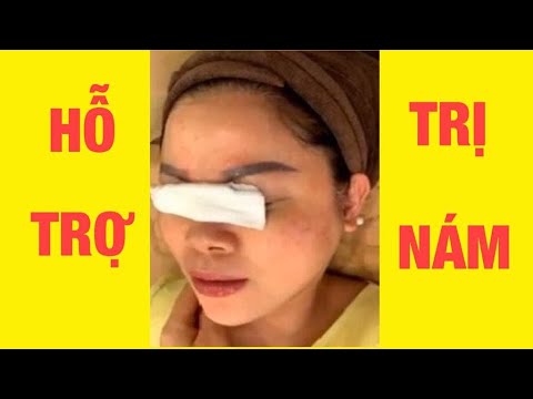 Hỗ trợ điều trị nám an toàn, hiệu quả, không để lại sẹo