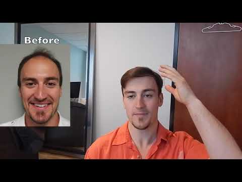 natural-hair-transplants-|-great-natural-hair-transplants-for-tampa,-florida