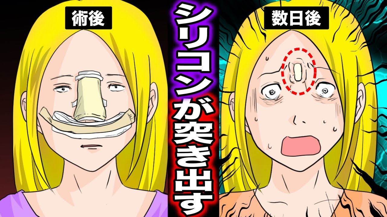 実話 鼻からシリコンが飛び出た女性が怖い 格安の整形手術で後悔した女性の末路 マンガ動画 Youtube