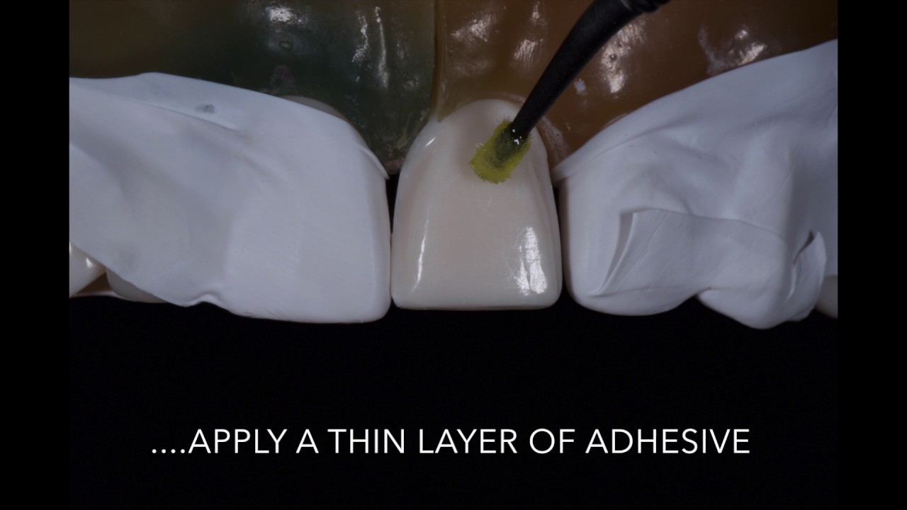 Porcelain Veneer Cementation step by step technique - YouTube