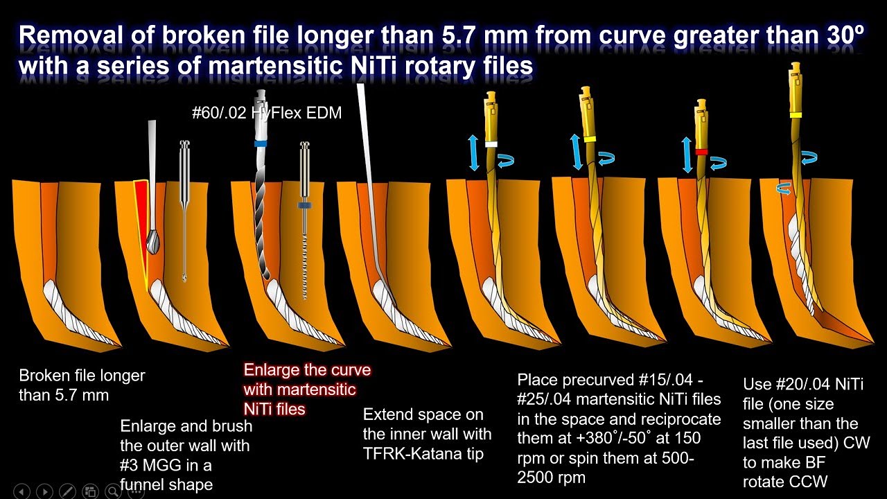 New removal technique for broken files longer than 5.7 mm/5.7 mm以上の破折器具除去の新たなテクニック
