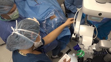 Performing Goniotomy with Kahook Dual Blade
