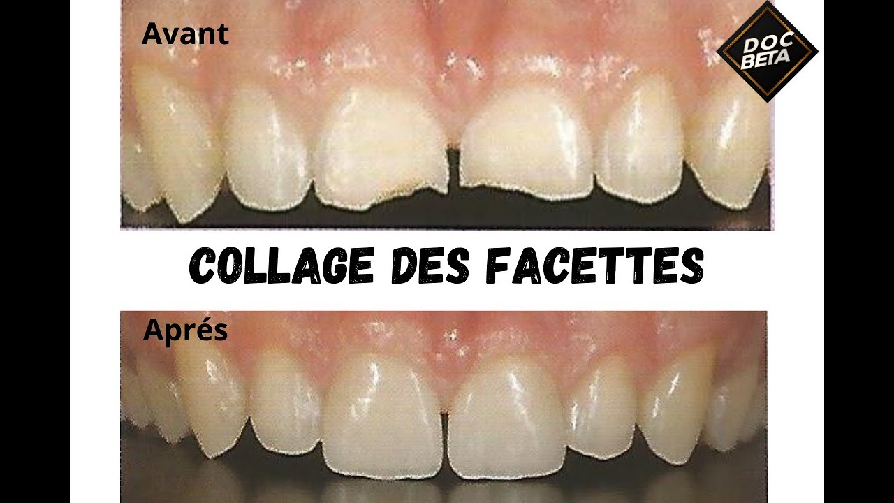 Facettes dentaires Collage YouTube — free download