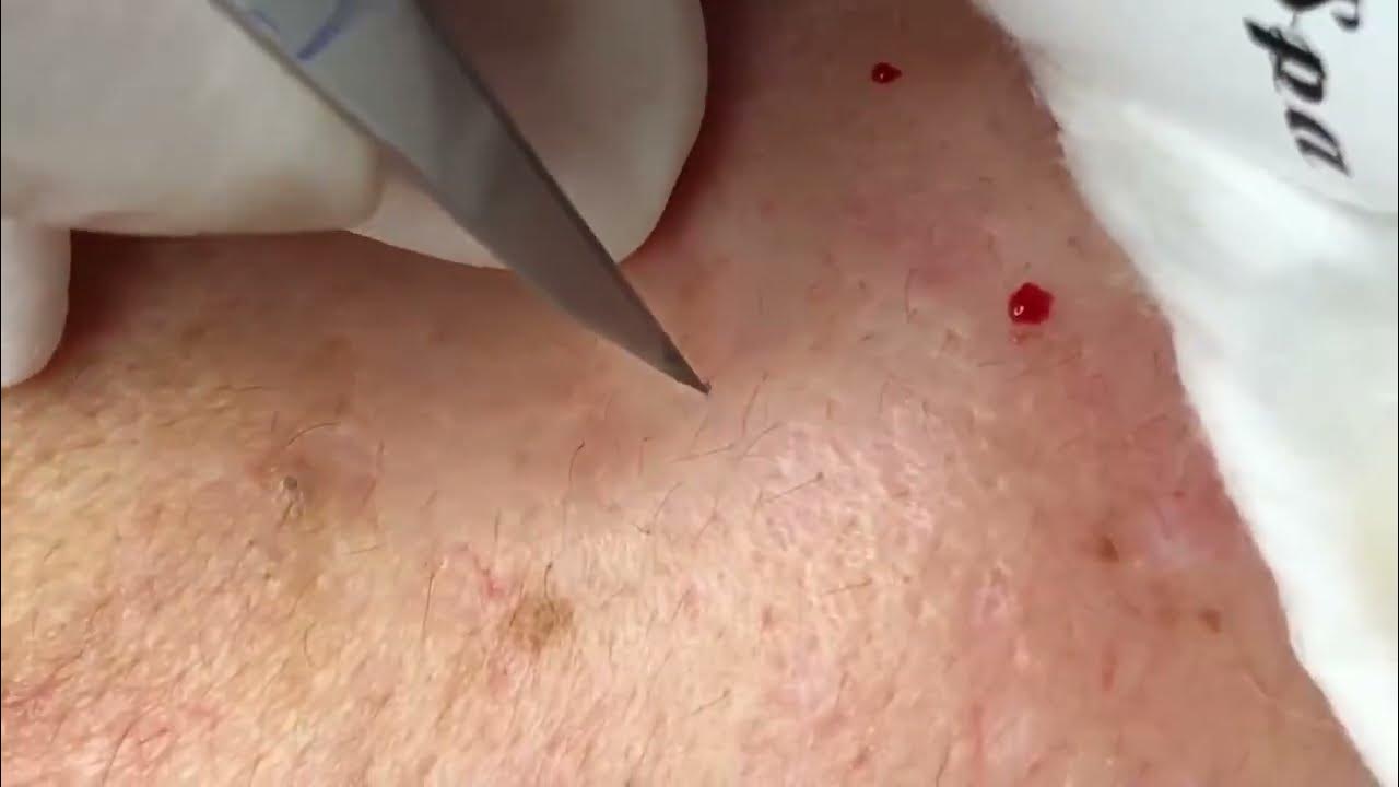 acne Blackheads Whiteheads Removal Blackhead extraction enilsa