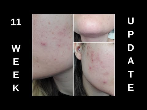 spironolactone-for-acne!-11-week-update!-(daily-skin-vlog!)---episode-#9