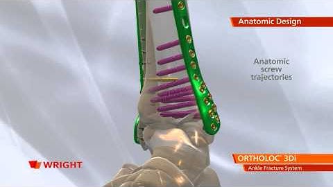 ORTHOLOC™ 3Di Ankle Fracture System Animation