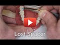 What to do about a lost spacer