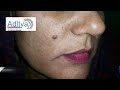 Mole Removal: Is It Safe ? | Skin Specialist Advice .