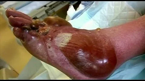 Pus Filled Blisters - Bizarre ER