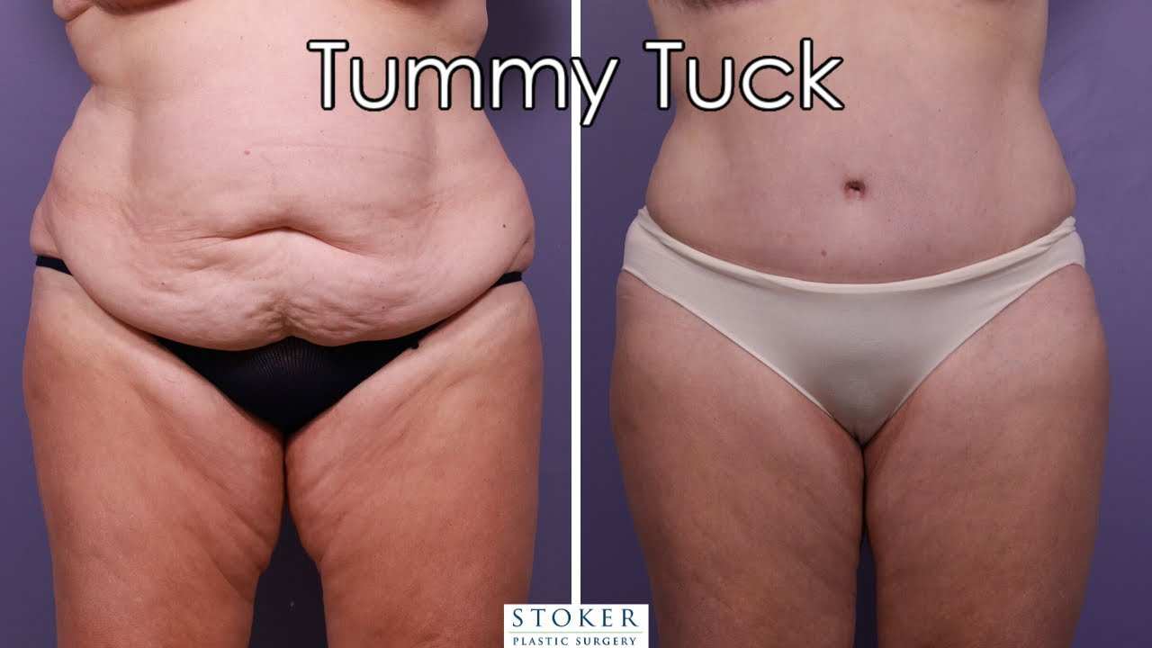 Tummy Tuck And Liposuction Los Angeles Plastic Surgeon Dr David