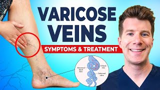 Doctor explains VARICOSE VEINS (including thread veins) | Causes, symptoms, treatment and prevention