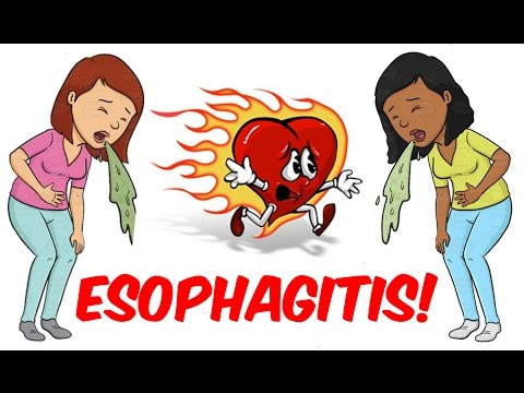 Video: Esophagitis: Typer, Symptom Och Riskfaktorer