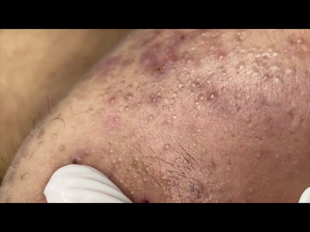 Huyen phan treatment acne #104 #nanmun #acne #mun #goldspa #huyenphan