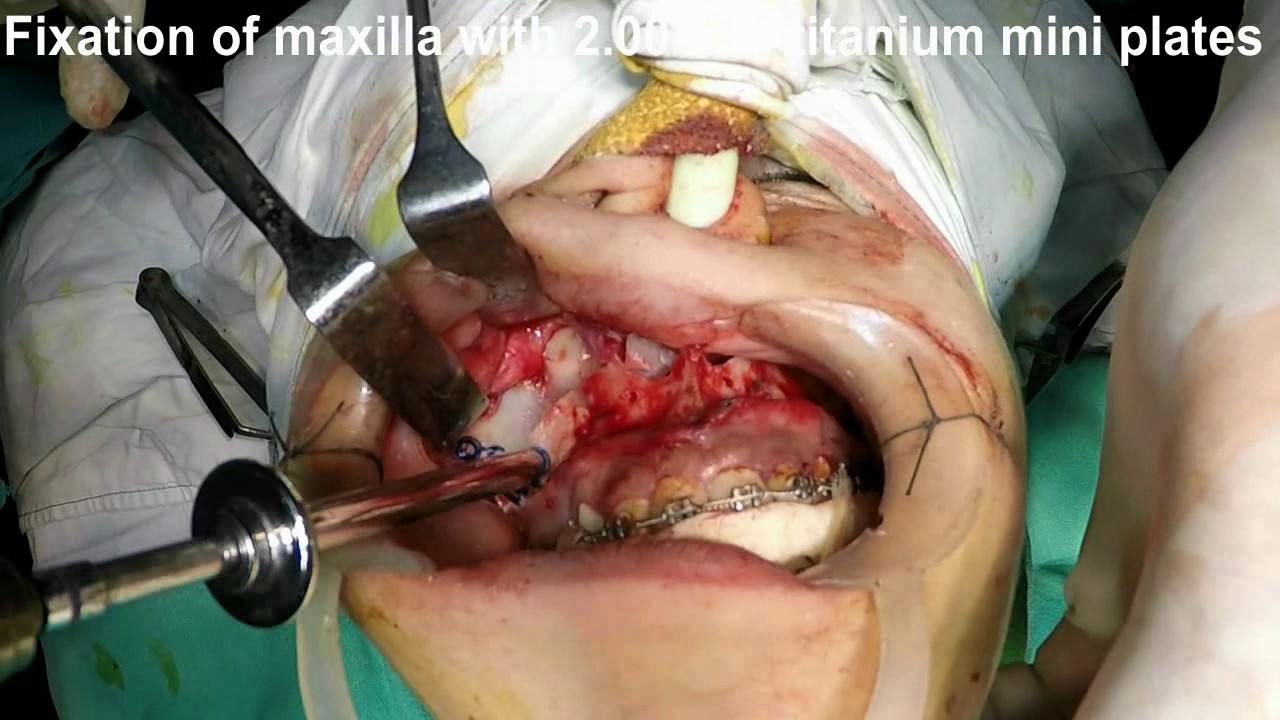 lefort osteotomies
