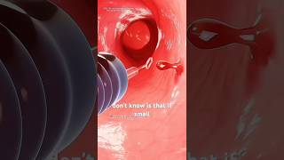 COLONOSCOPY #neet