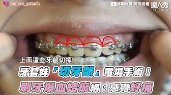 牙套日記 Youtube