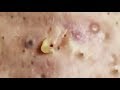 Big Open & Closed Blackheads Removal - The best Pimple Popping Videos