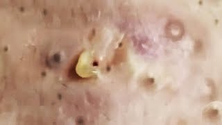 Big & Closed Blackheads Removal The best Pimple Popping Videos