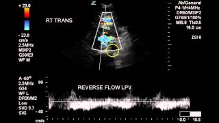 Abnormal Portal Vein Flow - Case Study