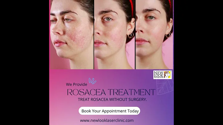 Rosacea Treatment  In Delhi, NCR
