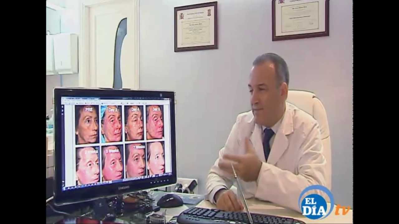 Acido Hialuronico Tenerife Botox Blefaroplastia Dr. Jorge Alvarez Marin  Milenium 