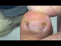 Double ingrown nail ,2 minutes to relief nail pain(Easy and effective skill)