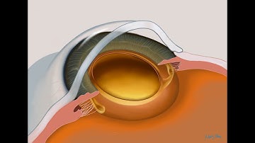 Routine cataract surgery